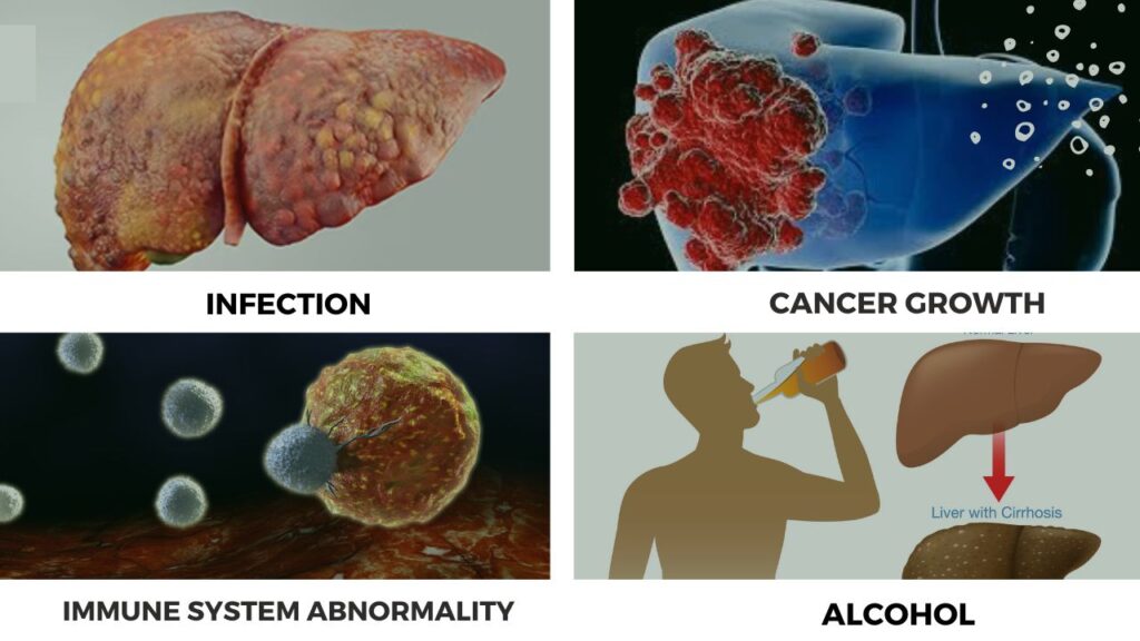 Causes of liver problems