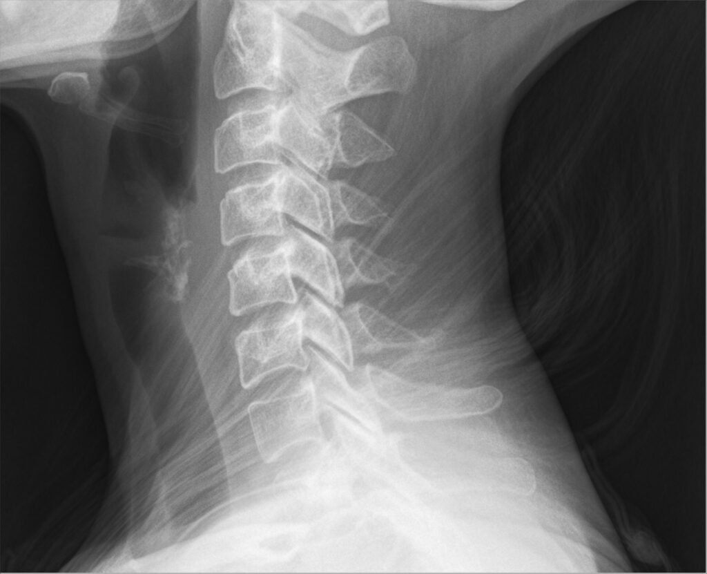 Can Ayurveda cure spondylosis? Let's dive deep down into the article!