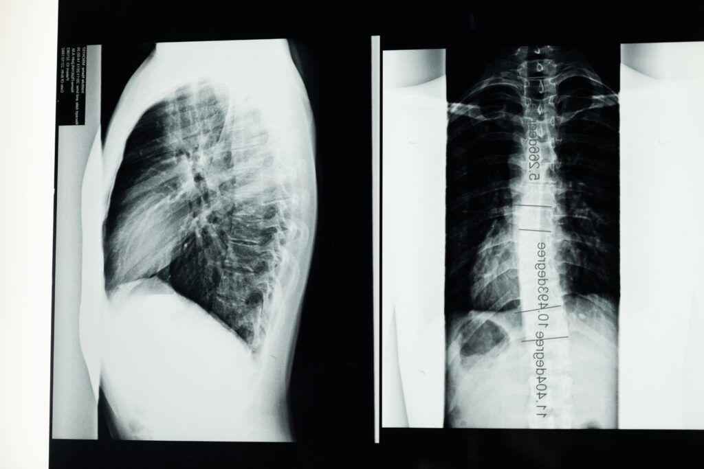 Can Ayurveda cure scoliosis? Let's find out!